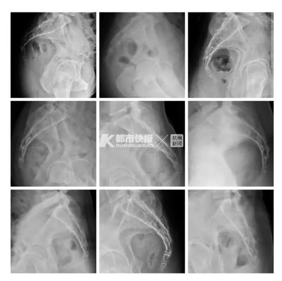 范炳华教授接诊的部分尾骨脱位女性患者影像片.医院供图
