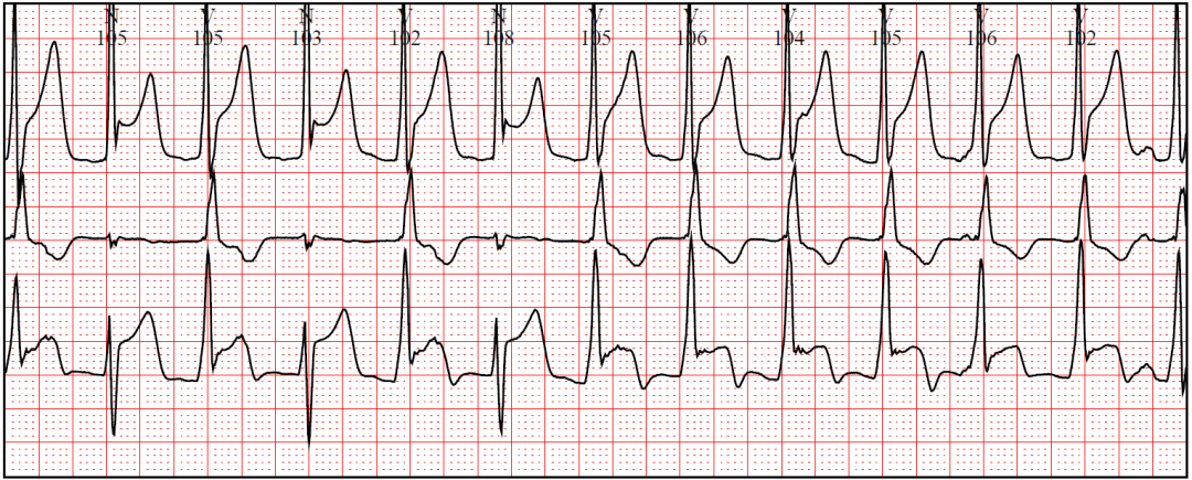 正常心电图 下:秦大伯的心电图 结合后来的冠状动脉cta检查结果