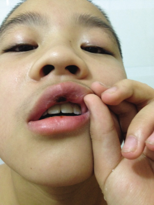 11岁男孩滑冰摔断两颗门牙 18岁之前吃饭都不能用门牙了