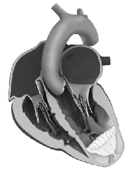 年轻人得心梗后警惕室壁瘤 这种病的死亡率高达23%
