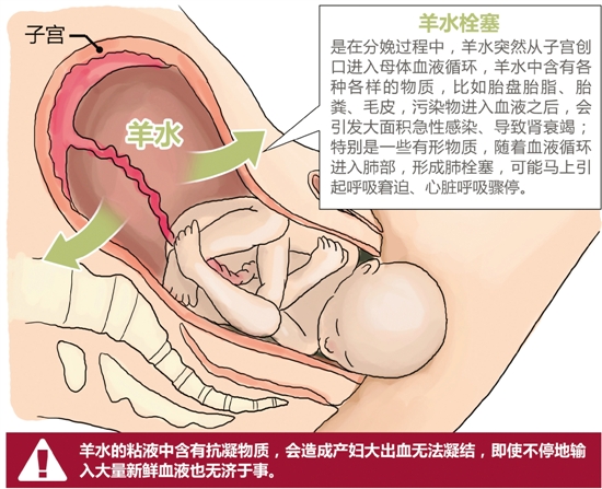 羊水栓塞凶险，连医生都怕