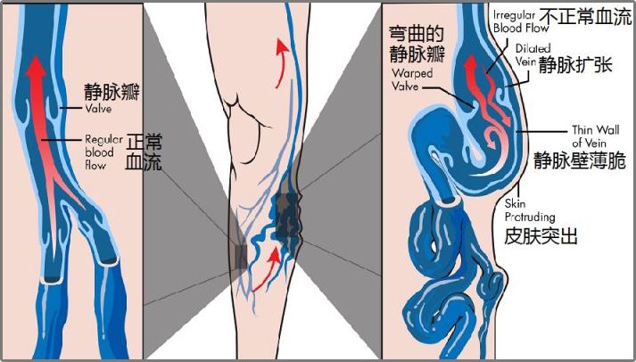 静脉瓣示意图图片