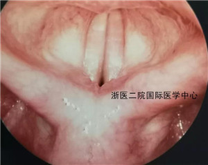 咽后壁癌早期症状图片图片